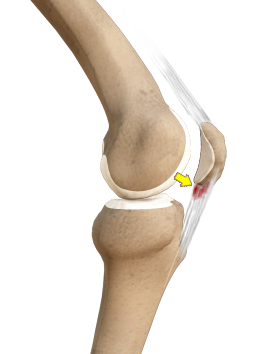 Tendonitis